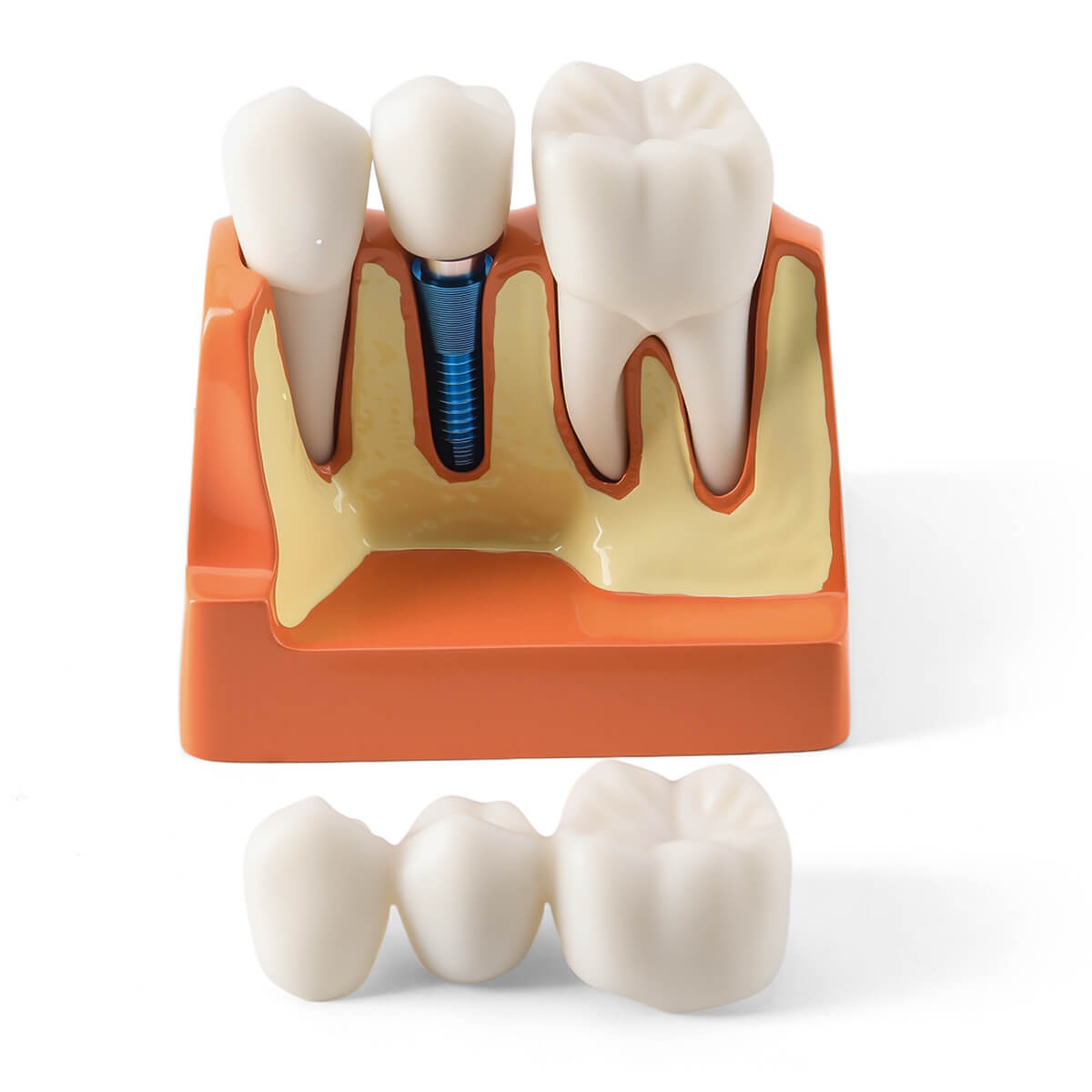 Dental 4 Times Implant Teeth Model Analysis Crown Bridge Demonstration Removable - azdentall.com