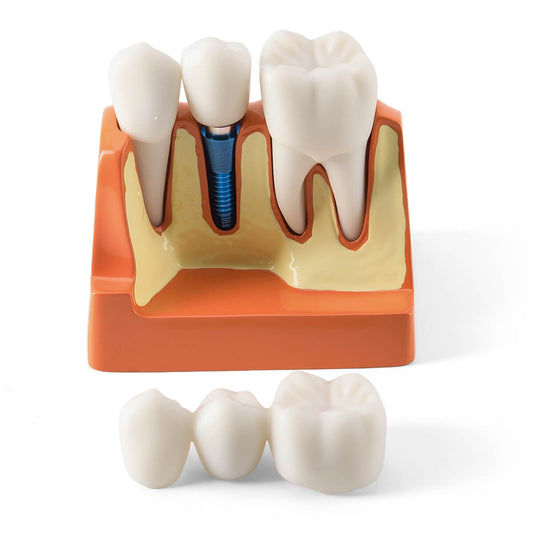Dental 4 Times Implant Teeth Model Analysis Crown Bridge Demonstration Removable - azdentall.com