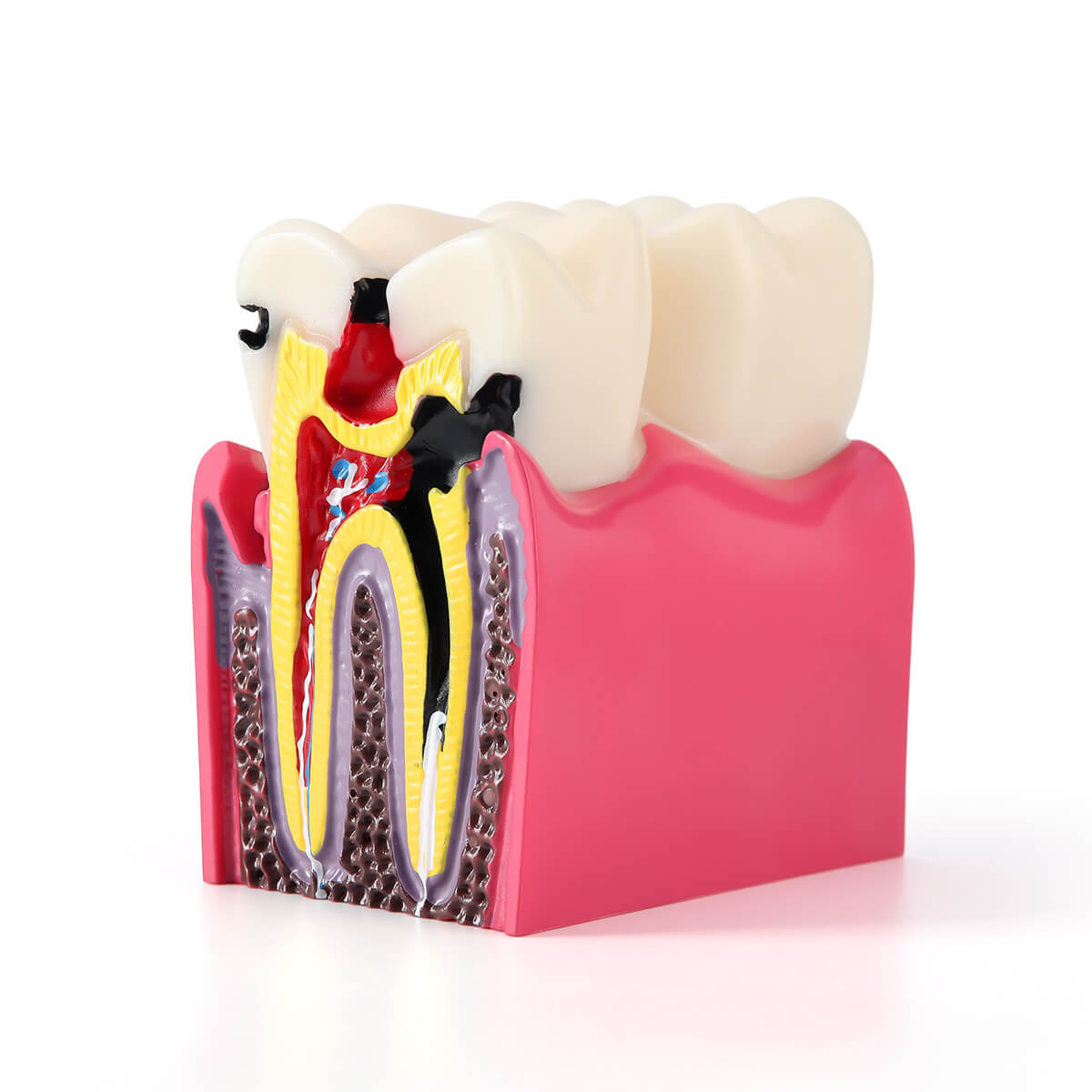 Dental Caries Tooth Model 6 Times Decay Teeth Comparative Study Model - azdentall.com