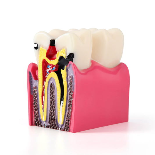 Dental Caries Tooth Model 6 Times Decay Teeth Comparative Study Model - azdentall.com