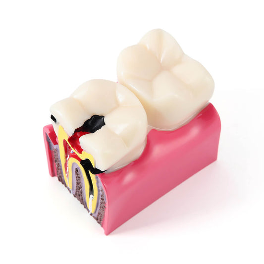 Dental Caries Tooth Model 6 Times Decay Teeth Comparative Study Model - azdentall.com