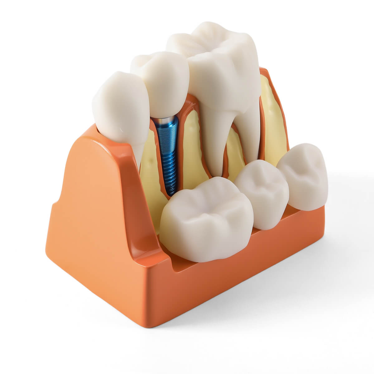 Dental 4 Times Implant Teeth Model Analysis Crown Bridge Demonstration Removable - azdentall.com