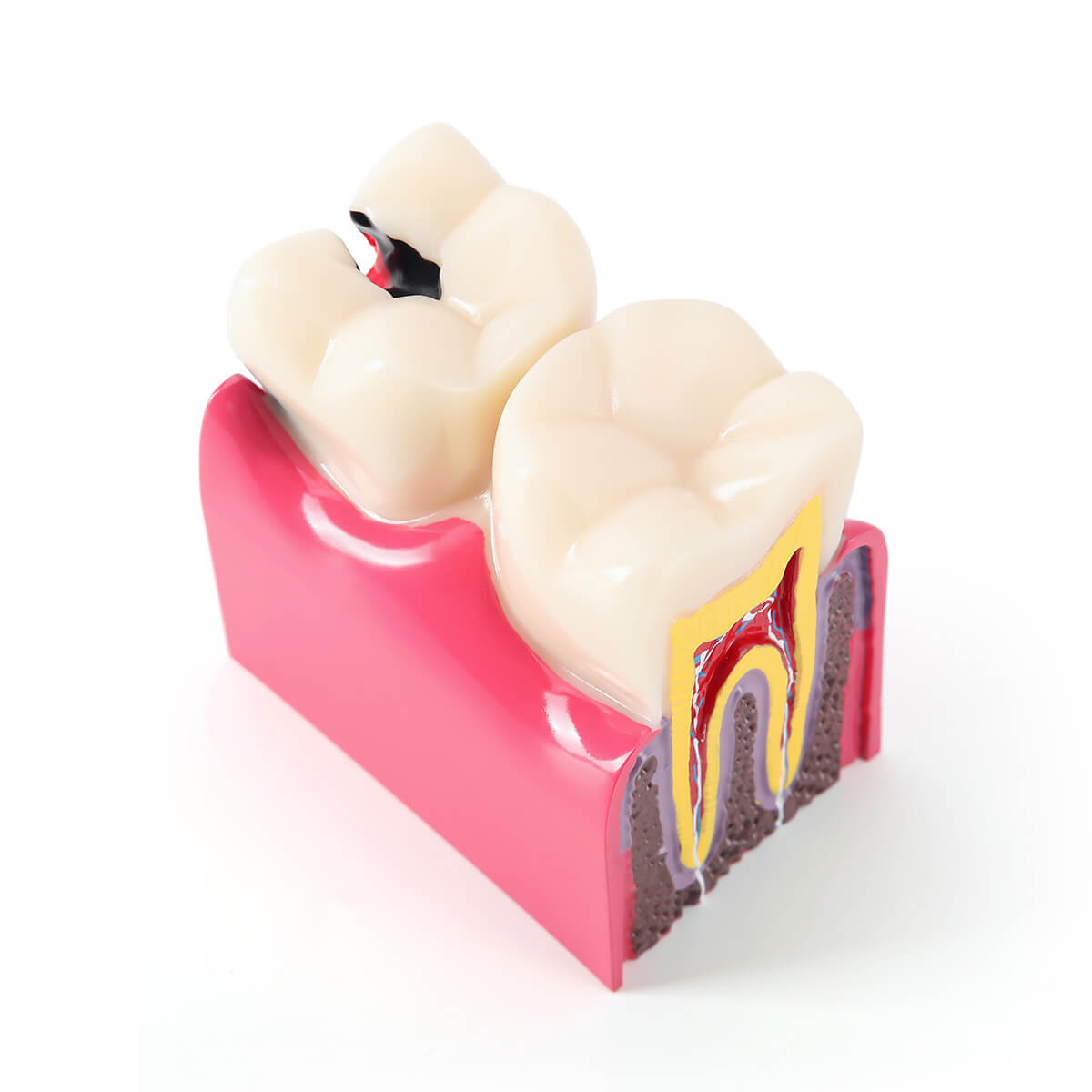 Dental Caries Tooth Model 6 Times Decay Teeth Comparative Study Model - azdentall.com