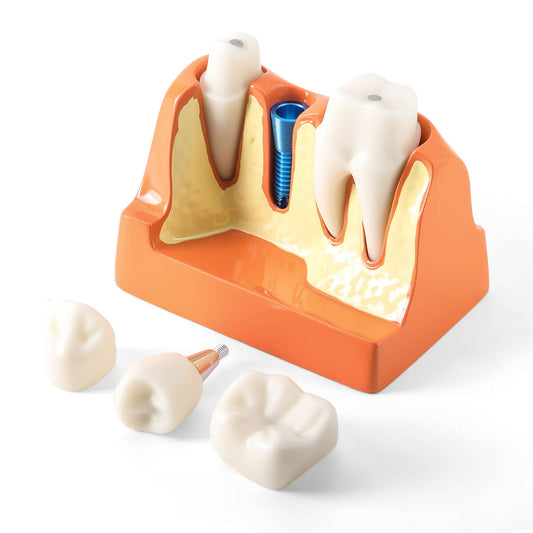 Dental 4 Times Implant Teeth Model Analysis Crown Bridge Demonstration Removable - azdentall.com
