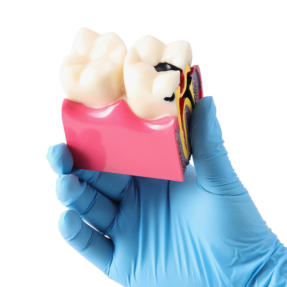 Dental Caries Tooth Model 6 Times Decay Teeth Comparative Study Model - azdentall.com