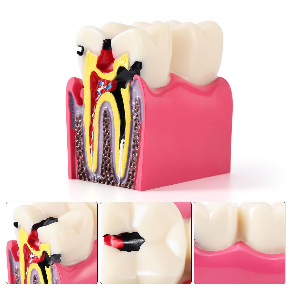 Dental Caries Tooth Model 6 Times Decay Teeth Comparative Study Model - azdentall.com