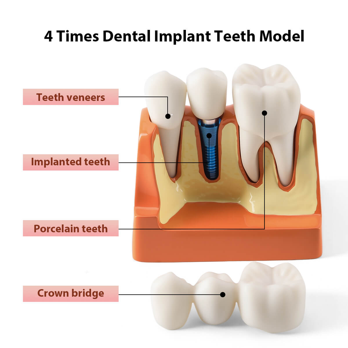 Dental 4 Times Implant Teeth Model Analysis Crown Bridge Demonstration Removable - azdentall.com