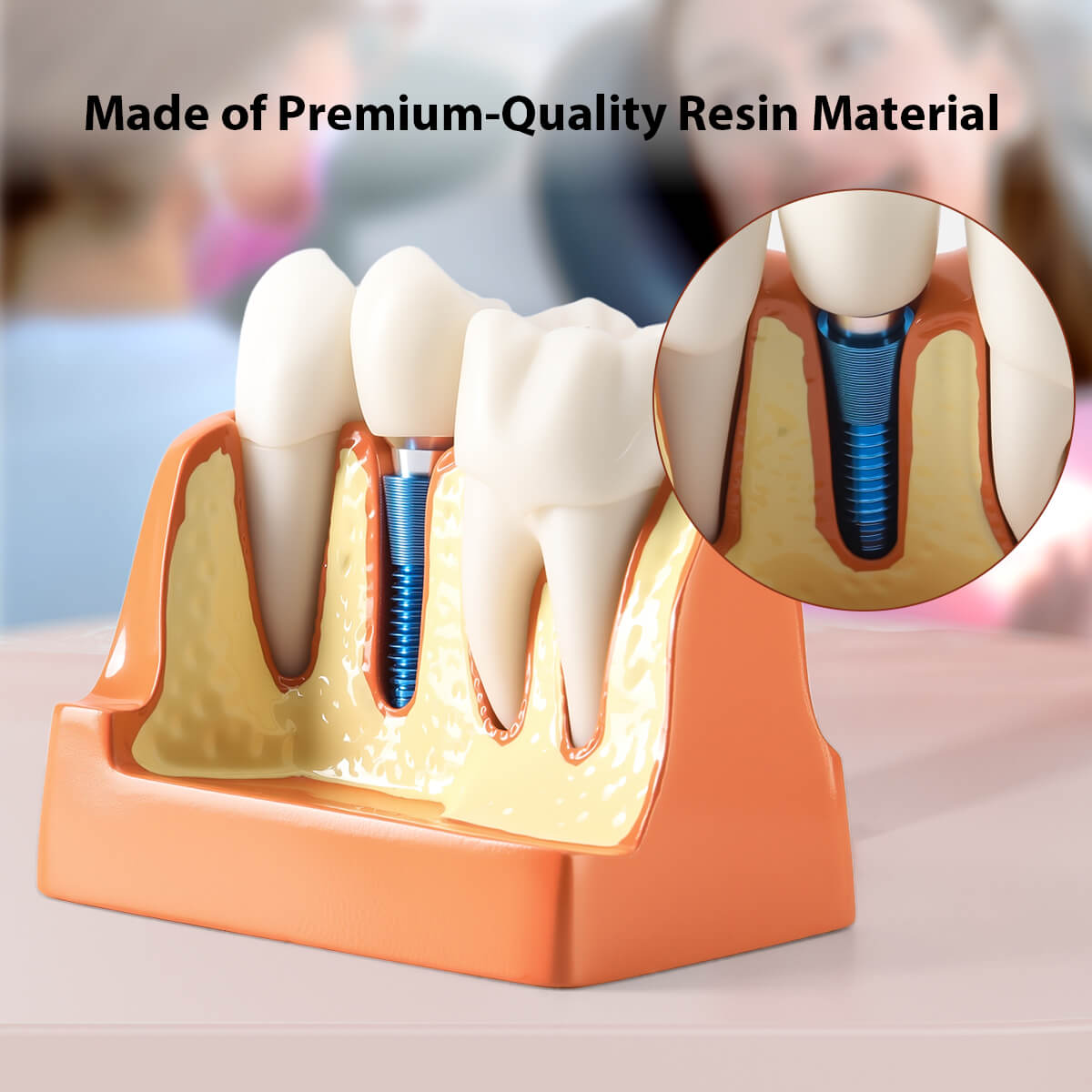 Dental 4 Times Implant Teeth Model Analysis Crown Bridge Demonstration Removable - azdentall.com