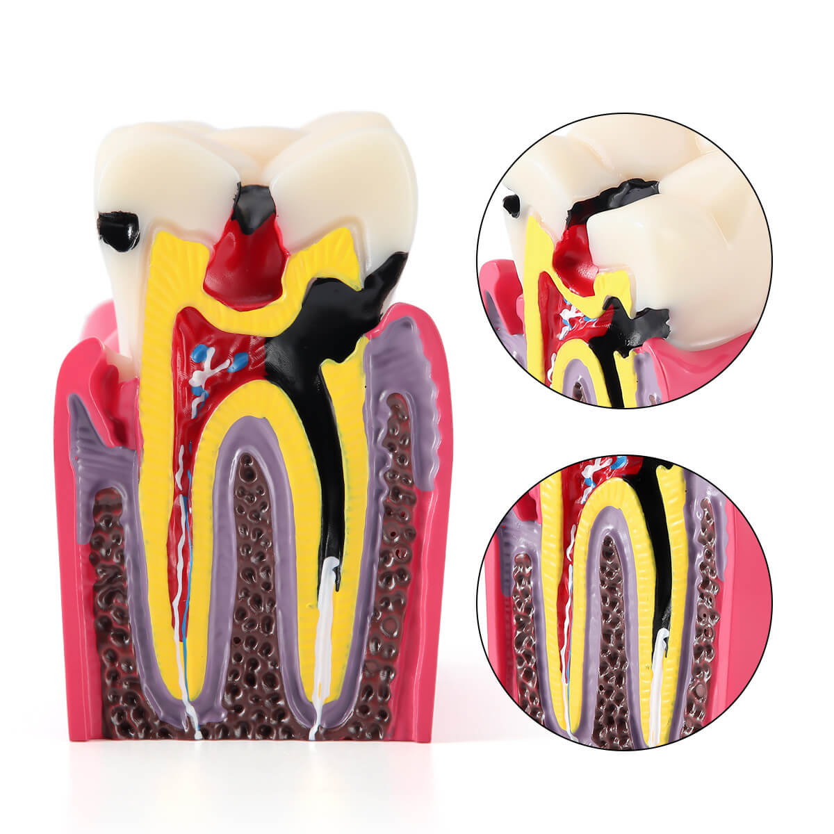 Dental Caries Tooth Model 6 Times Decay Teeth Comparative Study Model - azdentall.com