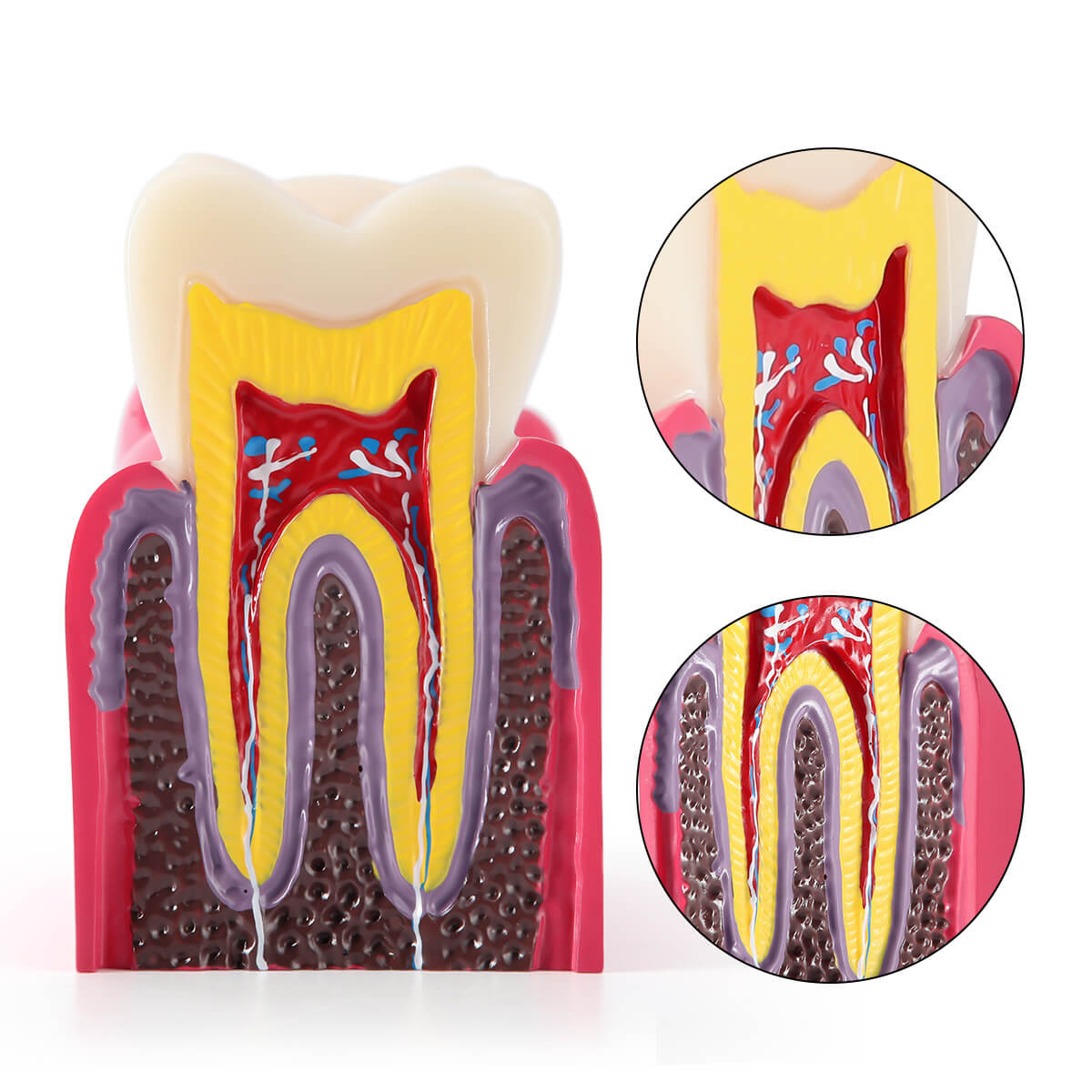 Dental Caries Tooth Model 6 Times Decay Teeth Comparative Study Model - azdentall.com