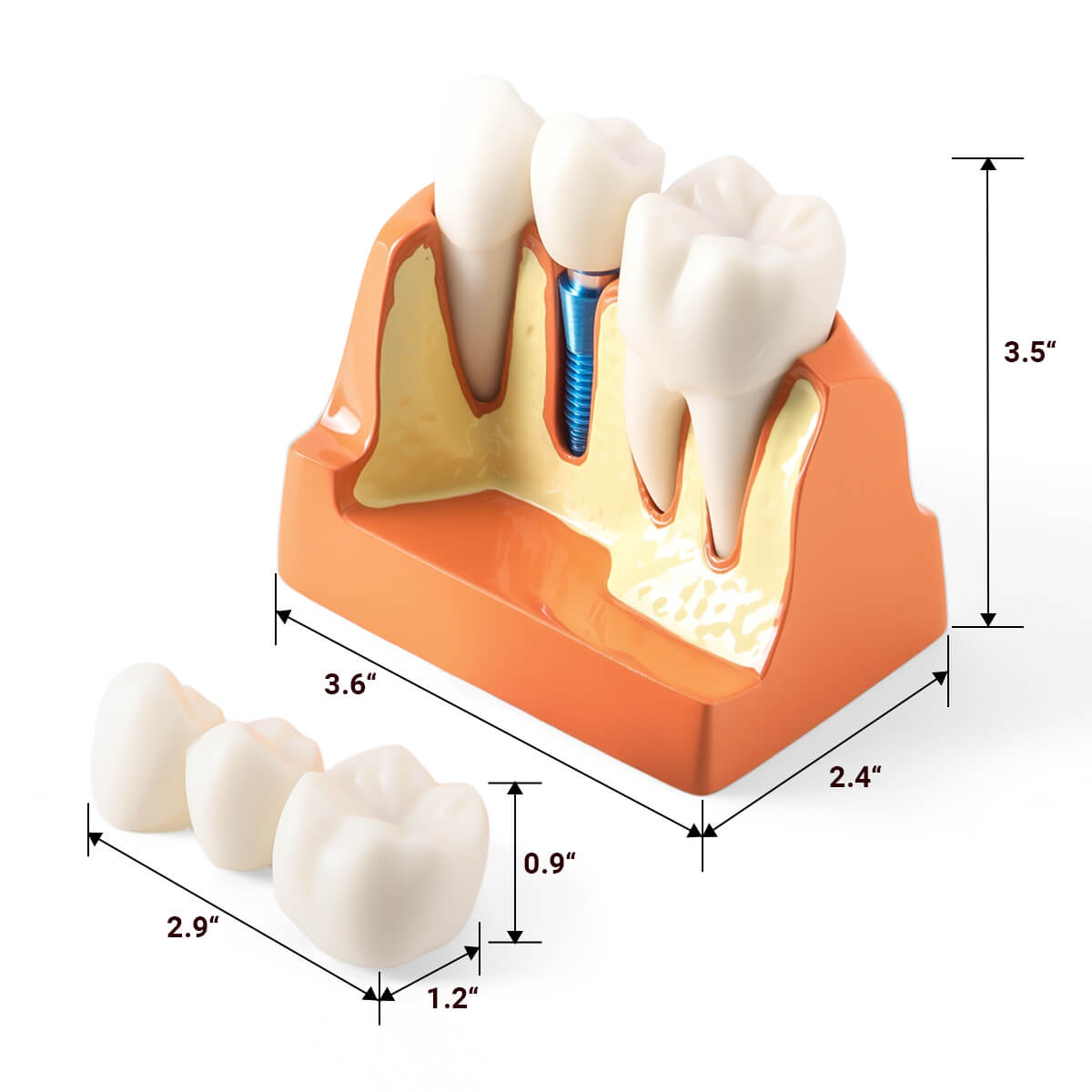 Dental 4 Times Implant Teeth Model Analysis Crown Bridge Demonstration Removable - azdentall.com