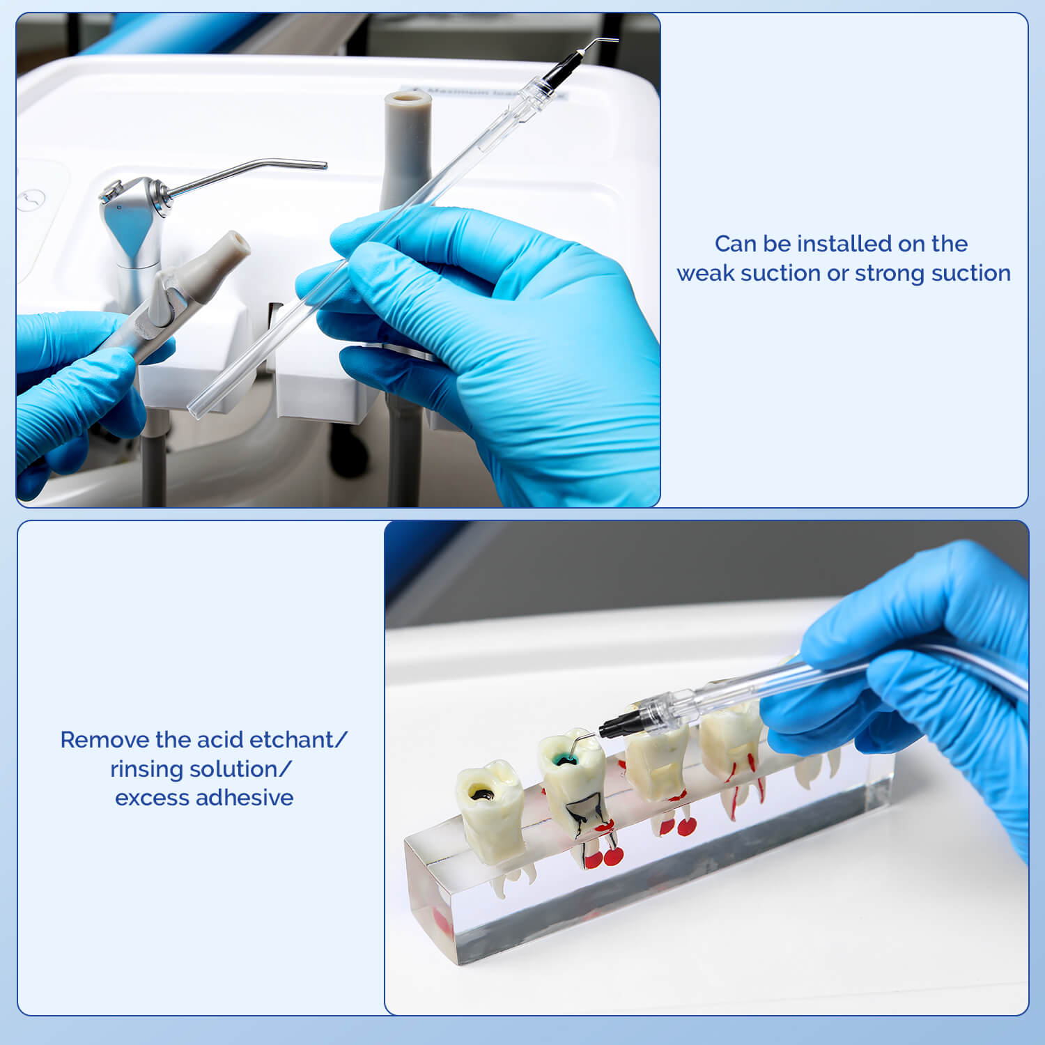 Disposable Saliva Ejector Tube with Irrigation Needle Tips 20 Kits/ Pack - azdentall.com