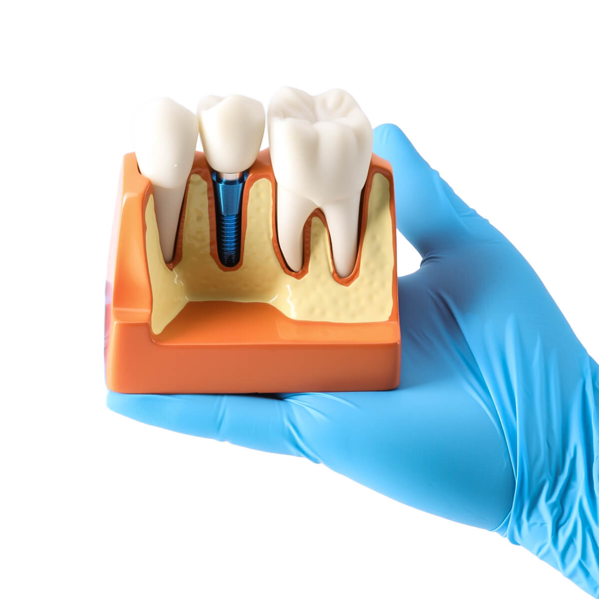 Dental 4 Times Implant Teeth Model Analysis Crown Bridge Demonstration Removable - azdentall.com