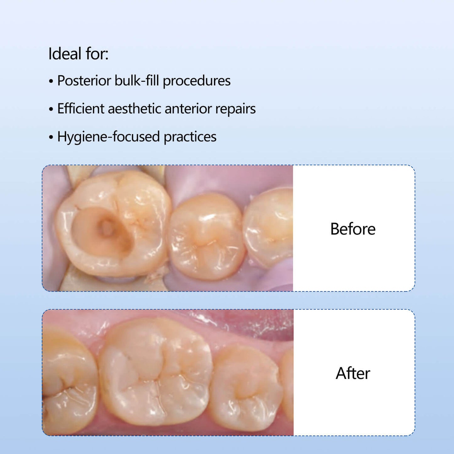 Dental Nano-Ceramic Composite Resin Light Cure Capsule A1/A2/A3/A3.5 0.3gx10 capsule/Box - azdentall.com