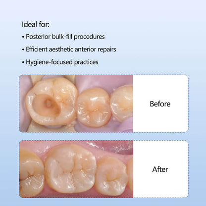 Dental Nano-Ceramic Composite Resin Light Cure Capsule A1/A2/A3/A3.5 0.3gx10 capsule/Box - azdentall.com