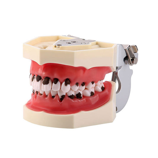 Dental Calculus Model Periodontal Disease Model Education Demonstration Removable Tooth