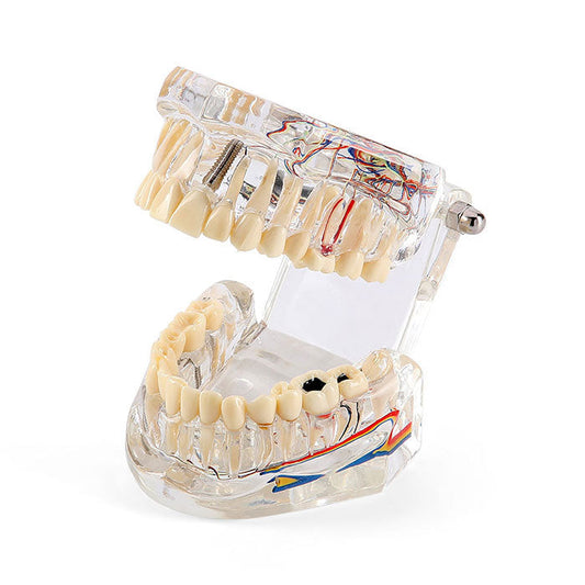 Dental Oral Typodont Model Implant Pathological Removable Teach Demo Transparent - azdentall.com