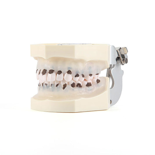 Dental Transparent  Calculus Model Periodontal Disease Model With Removable Tooth Education Demonstration Typodont - azdentall.com